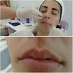 Depilação com linha
