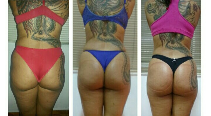 Antes /depois tratamento para perda de medidas e modelagem do bumbum.  estética esteticista micropigmentador(a) designer de sobrancelhas depilador(a)
