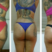 Antes /depois tratamento para perda de medidas e modelagem do bumbum. 