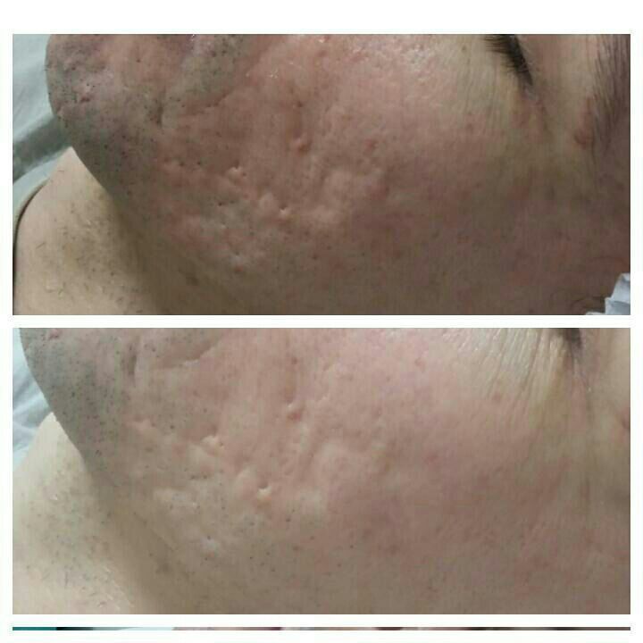 Microagulhamento pára cicatriz de acne 1 sessão estética esteticista dermopigmentador(a) designer de sobrancelhas