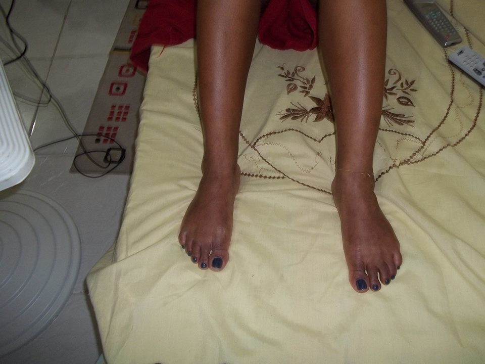 Depois- Tratamento manchas corporais. estética esteticista cosmetólogo(a) consultor(a) outros