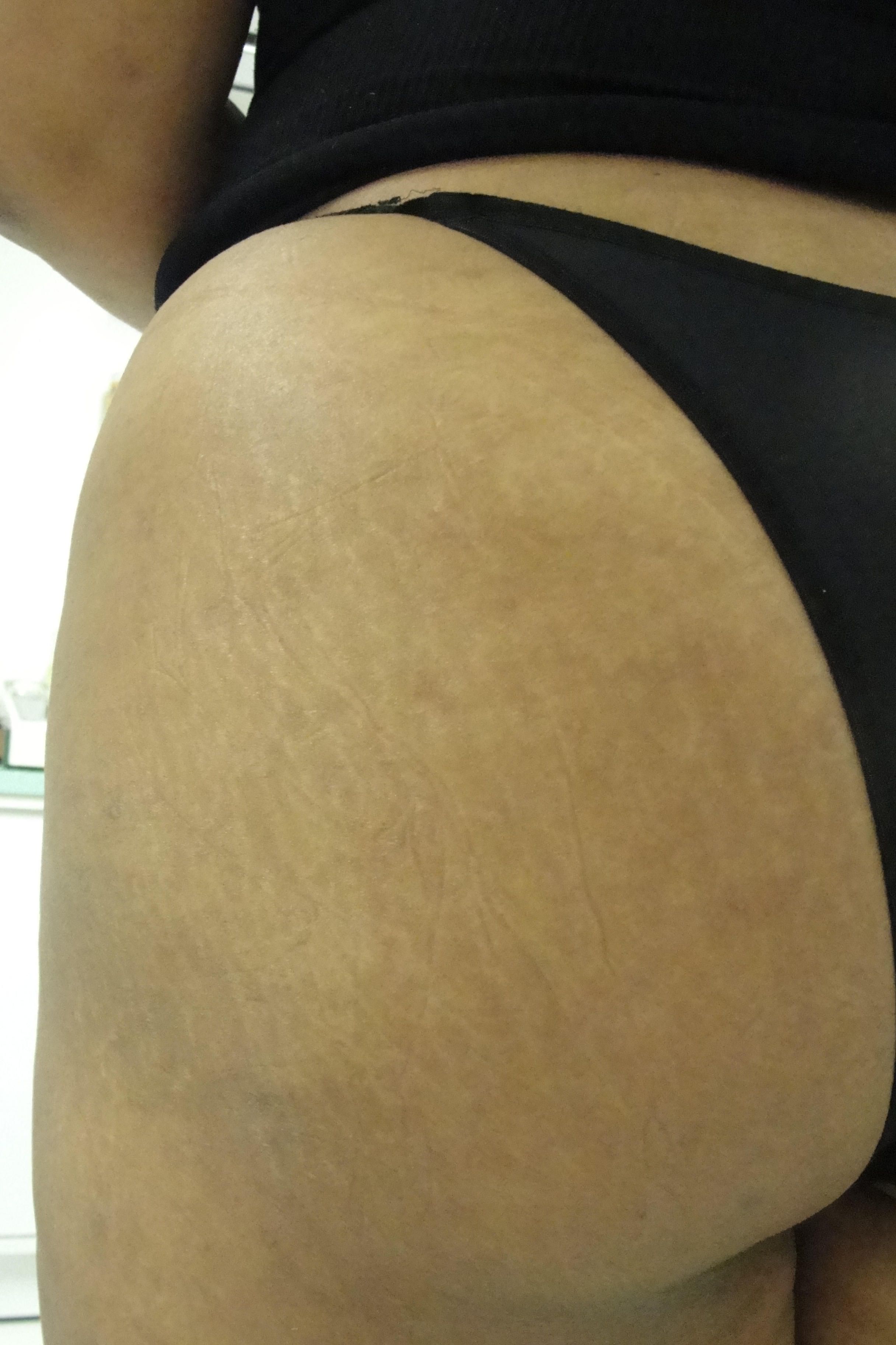 Estrias depois- estética esteticista cosmetólogo(a) consultor(a) outros