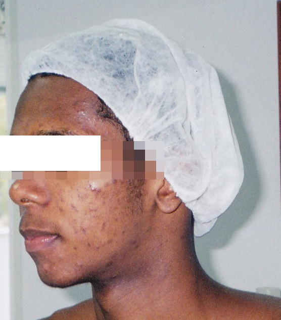 Acne e suas sequelas - antes estética esteticista cosmetólogo(a) consultor(a) outros