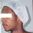 Acne e suas sequelas - antes
