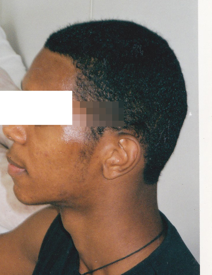 Acne e suas sequelas - Depois estética esteticista cosmetólogo(a) consultor(a) outros