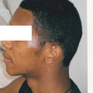 Acne e suas sequelas - Depois