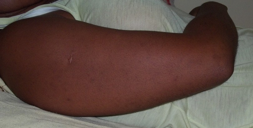 Depois- Tratamento manchas - Picada de inseto estética esteticista cosmetólogo(a) consultor(a) outros