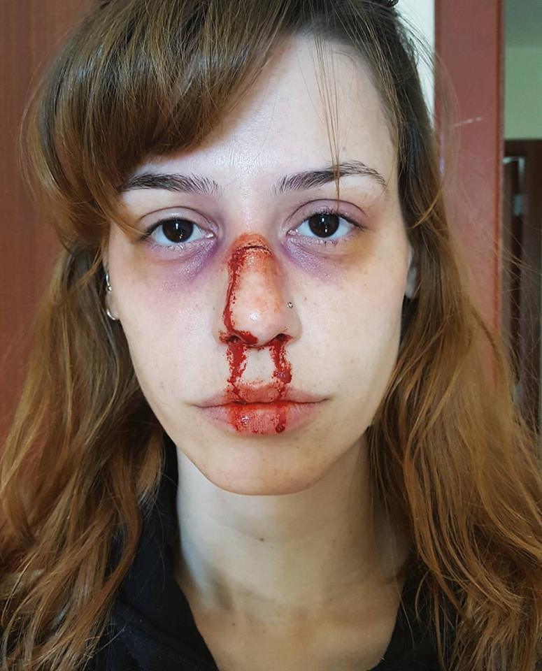 Nariz quebrado feito com scar war. 
#brokennose #sfxmakeup #makeupartist maquiagem