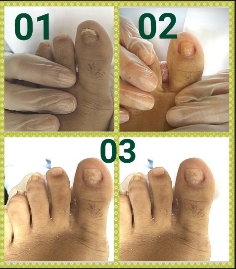 Reconstrução da lâmina ungueal (órtese acrílica). unha podólogo(a) manicure e pedicure