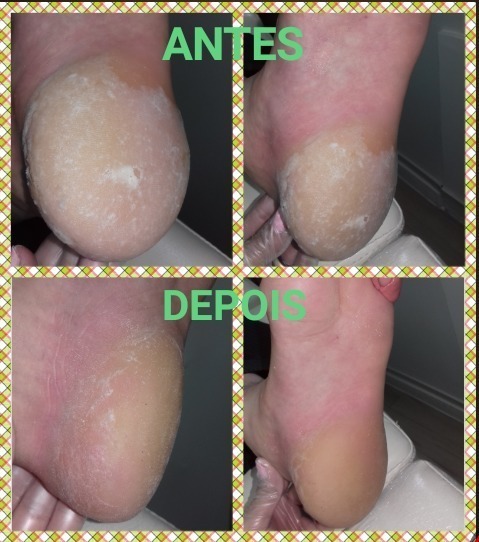 Profilaxia (região do calcâneo com excesso de queratose). estética podólogo(a) manicure e pedicure