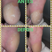 Profilaxia (região do calcâneo com excesso de queratose).