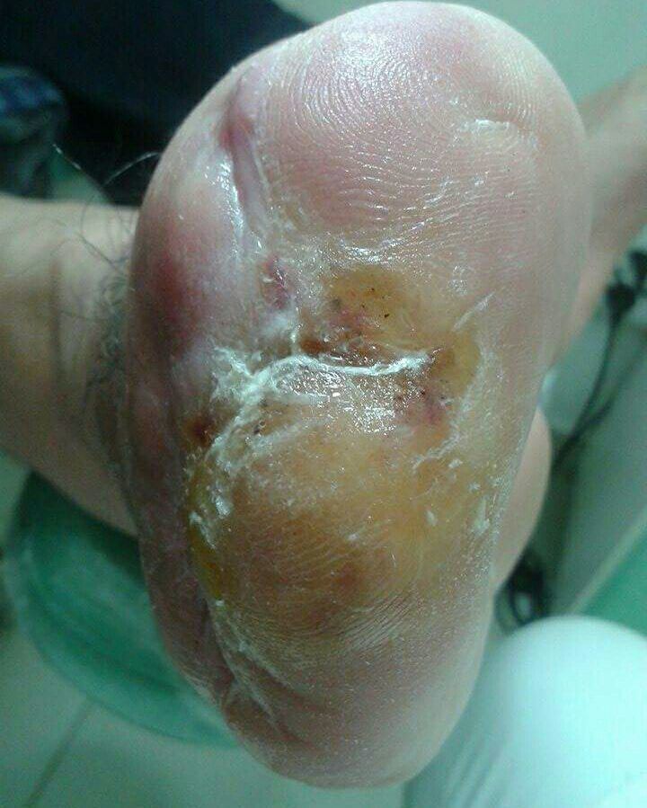 Paciente diabético em procedimento de retirada de calosidade onde estava perfurando dificultando a cicatrização da amputação. outros podólogo(a)