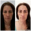 Micropigmentação técnica Esfumada!
Após 30 dias irá clarear de 30% a 50% a cor, ficando um aspecto mais natural.