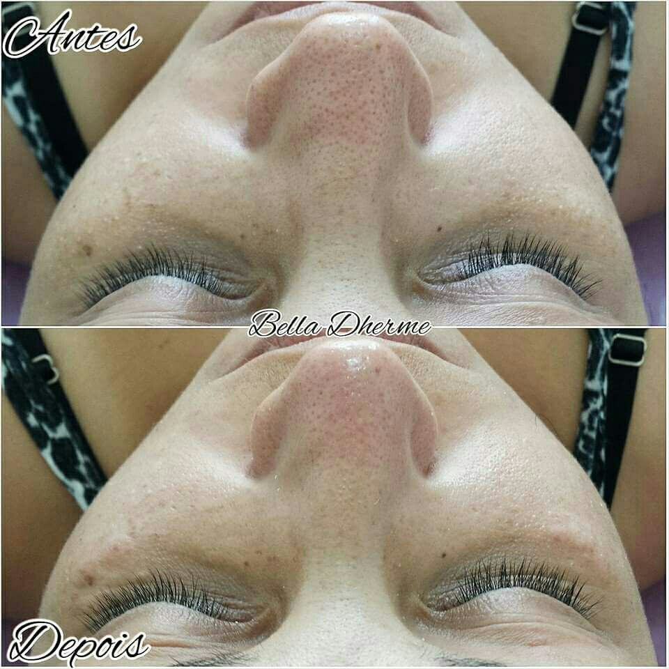 Limpeza de pele!!! estética micropigmentador(a) designer de sobrancelhas