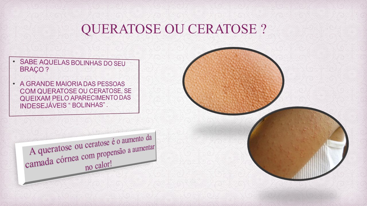 A ceratose ou queratose pilar é um disfunção estética ocasionada pela inflamação do folículo piloso e pode causar coceira e incomodo estético para muitas pessoas. Venha conhecer os tratamentos específicos para seu tipo de pele em Giulia Valvano Estética  estética esteticista