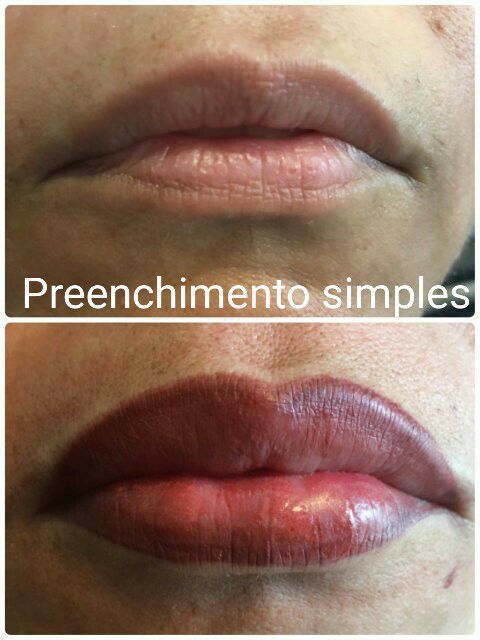 Independente da tendência e moda das cores, o batom será sempre um grande aliado das mulheres💄💄
Por uma questão de vaidade ou para correção de imperfeições causadas pelo envelhecimento cutâneo, acidentes que afetaram a região facial, ou alterações genéticas como fissuras labiopalatais, a micropigmentação é a solução para quem procura um resultado durável💋
Contorno e preenchimento simples; 3D ombrê; e 3 D ombrê sculptor ( iluminador que proporciona um efeito "lifiting").
#Micropigmentação #lábiosperfeitos #nadadebatom #diva #perfeição #studiobelezaperfeita maquiagem micropigmentador(a) dermopigmentador(a)