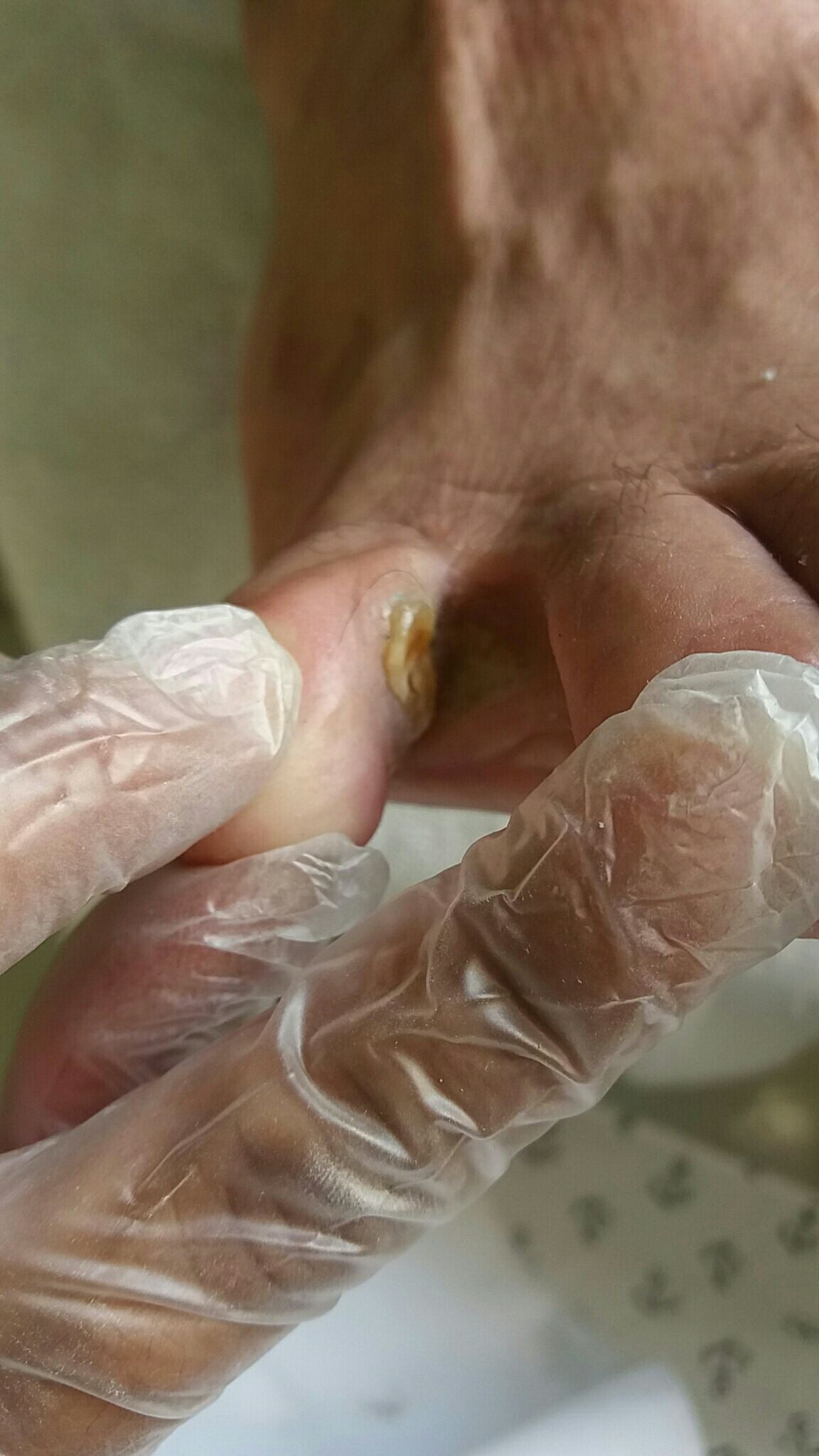 Calo interdigital 
Realizado assepsia,desbaste  Com lâmina de bisturi 15 e retirada do núcleo com enucleadora..cliente feliz e satisfeito. outros podólogo(a) manicure e pedicure