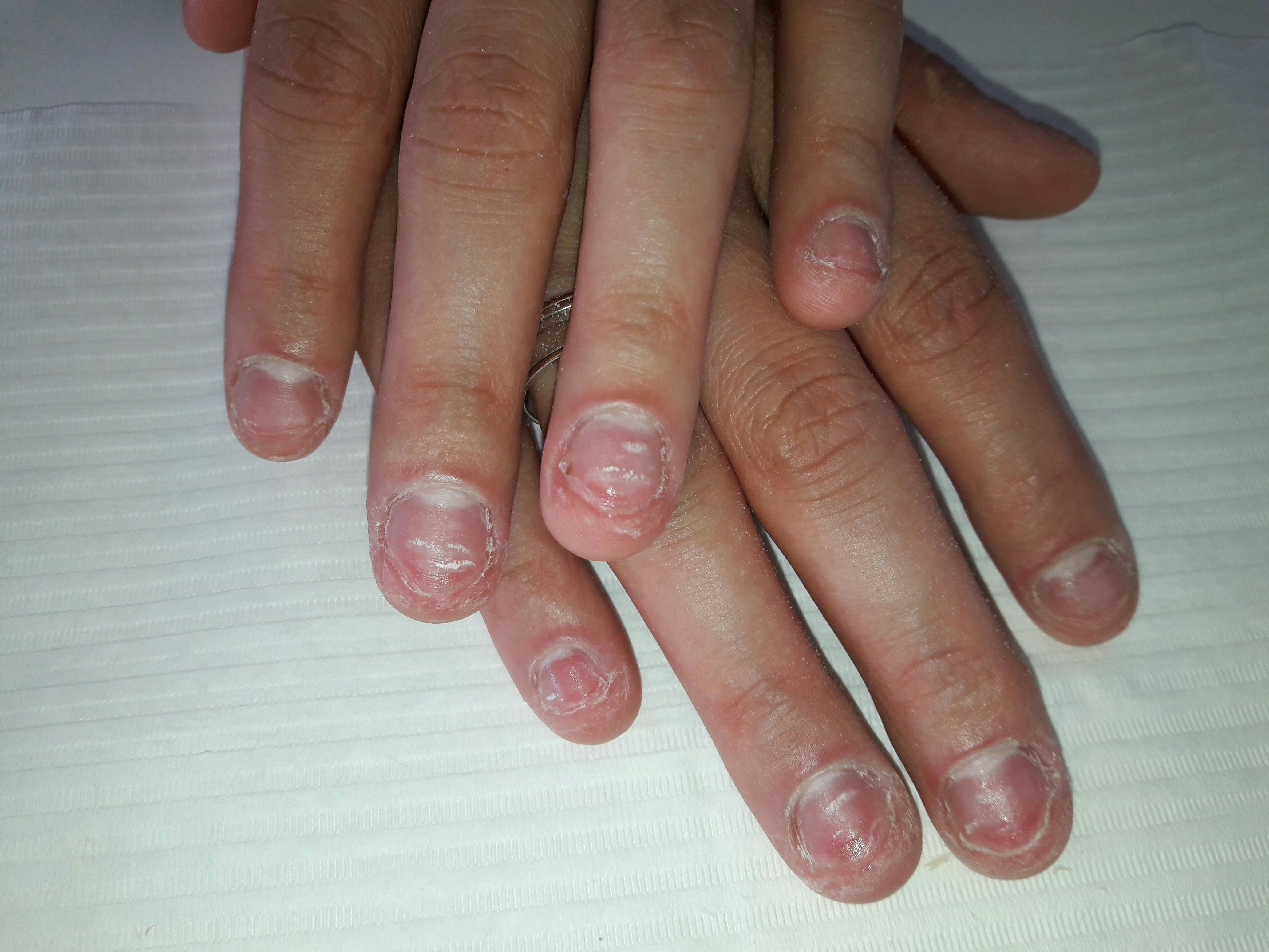 Quando uma cliente aparece assim....Já sabemos que ela sofre de onicofagia  (o hábito de roer as unhas) sabemos que isso atinge a auto estima dela fazendo com que não se arrume, não se sinta mulher, perca o seu poder de mulher.
Acredite unhas bem feitas são uma mudança  na auto estima.  Essa cliente trabalha com vendas e tinha vergonha de mostrar as mãos.  Vamos mudar isso! unha manicure e pedicure massoterapeuta