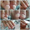 Homens atualmente não sentem mais vergonha em fazer as unhas e esse cliente em especial tem as unhas do dedão com lesões na matriz, sendo assim, as unhas já nascem com a estrutura e a forma prejudicada. Fizemos um banho de gel nas duas unhas para evitar que as mesmas racham e fiquem niveladas. Correction gel artístic nail