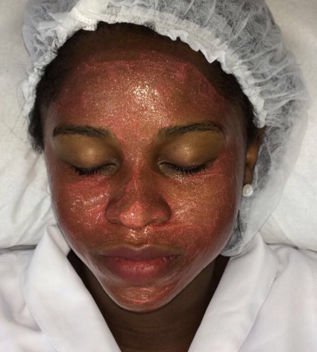 Protocolo Peeling estética esteticista depilador(a)