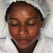 Protocolo Peeling