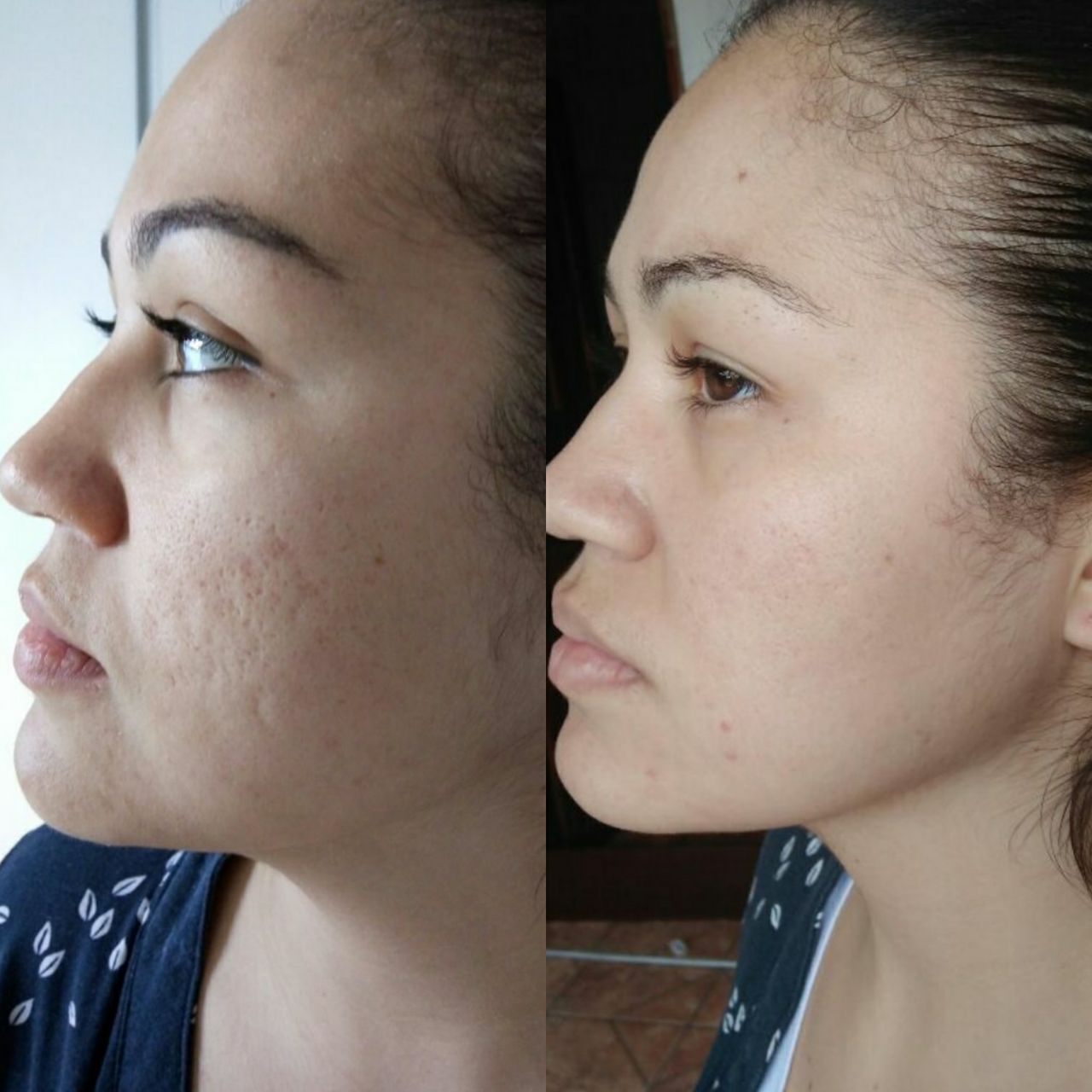 Get Microagulhamento Para Cicatriz De Acne Gif