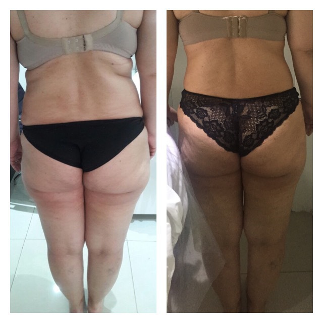 Redux Detox. 15 Sessões  estética esteticista