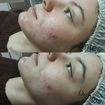 Limpeza de pele profunda, utilizado produtos profissionais da linha Vita Derm. Nesta foto , cliente possui rosto inchado após a extração de cravos e espinhas, foi utilizado mascara Fango cream de hidratação e nutrição.