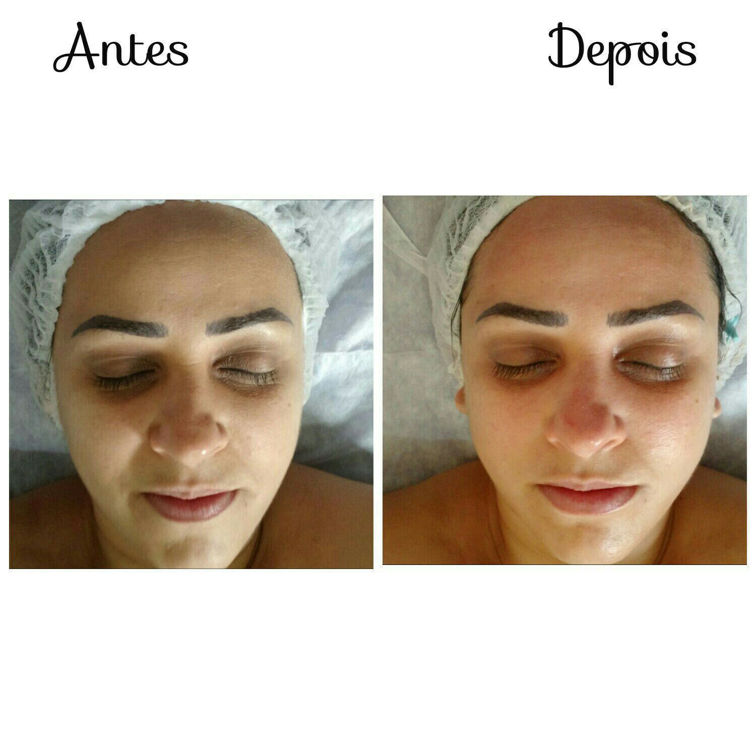 Foi feito 1 sessão de peeling ultrassonico na pele para melhora de linhas. Produtos utilizados By Sâmia. estética esteticista cosmetólogo(a)