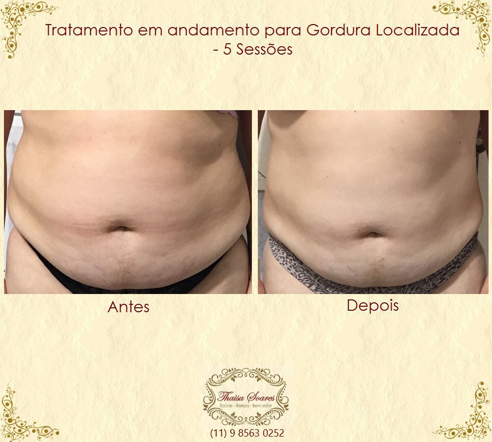 Resultado parcial do tratamento para lipodistrofia localizada estética esteticista designer de sobrancelhas