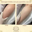 Antes e depois de 1 sessão de drenagem linfatica em pós operatório de cirurgia vascular