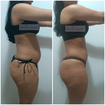 Resultado de três sessões de Massagem Modeladora 💆🏼