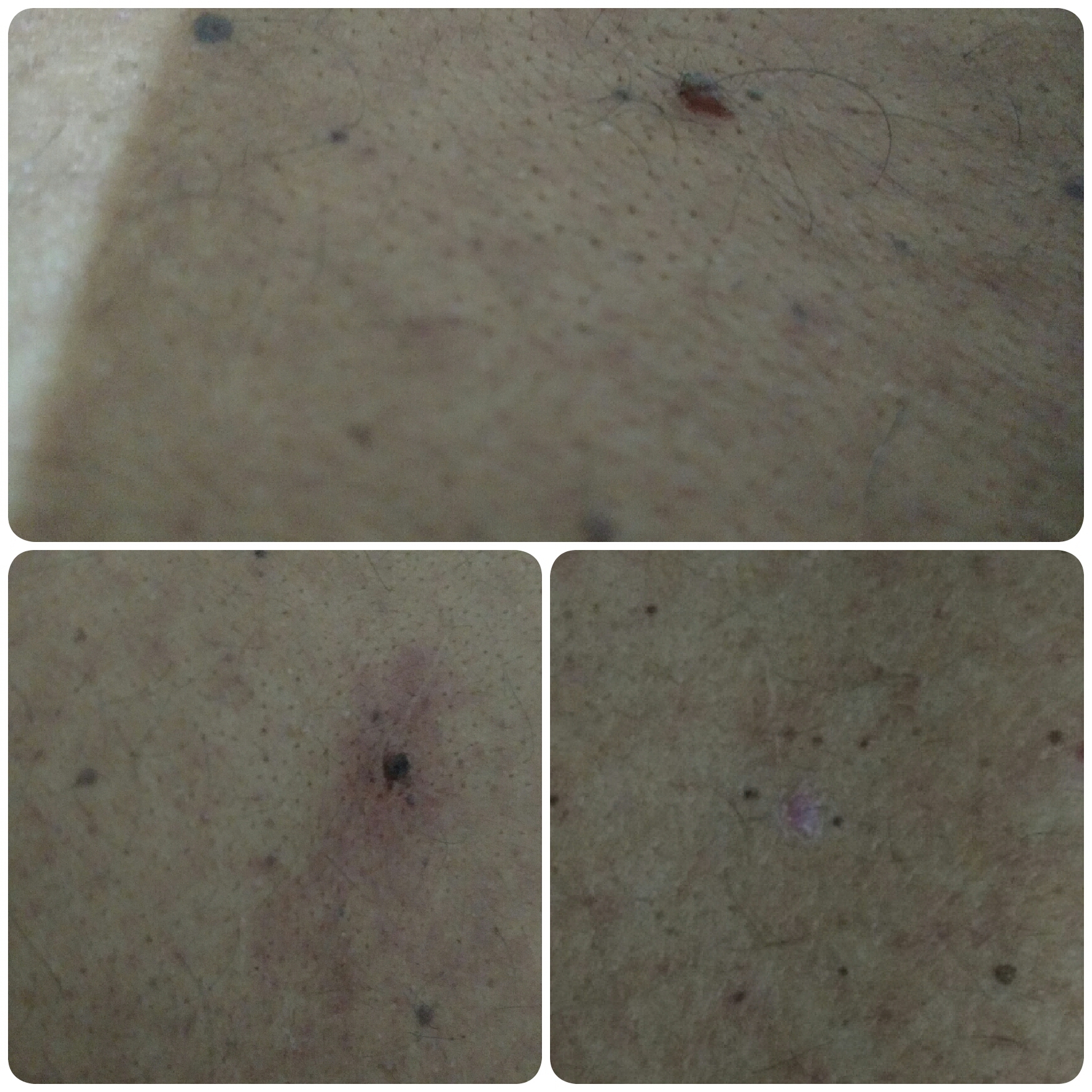 Remoção de verruga,.. / foto antes, durante e uma semana posa retirada estética esteticista