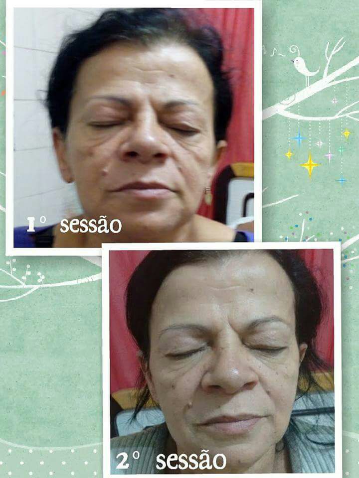 Tratamento de revitalização com microcorrentes estética esteticista