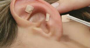 Acupuntura auricular outros acupunturista