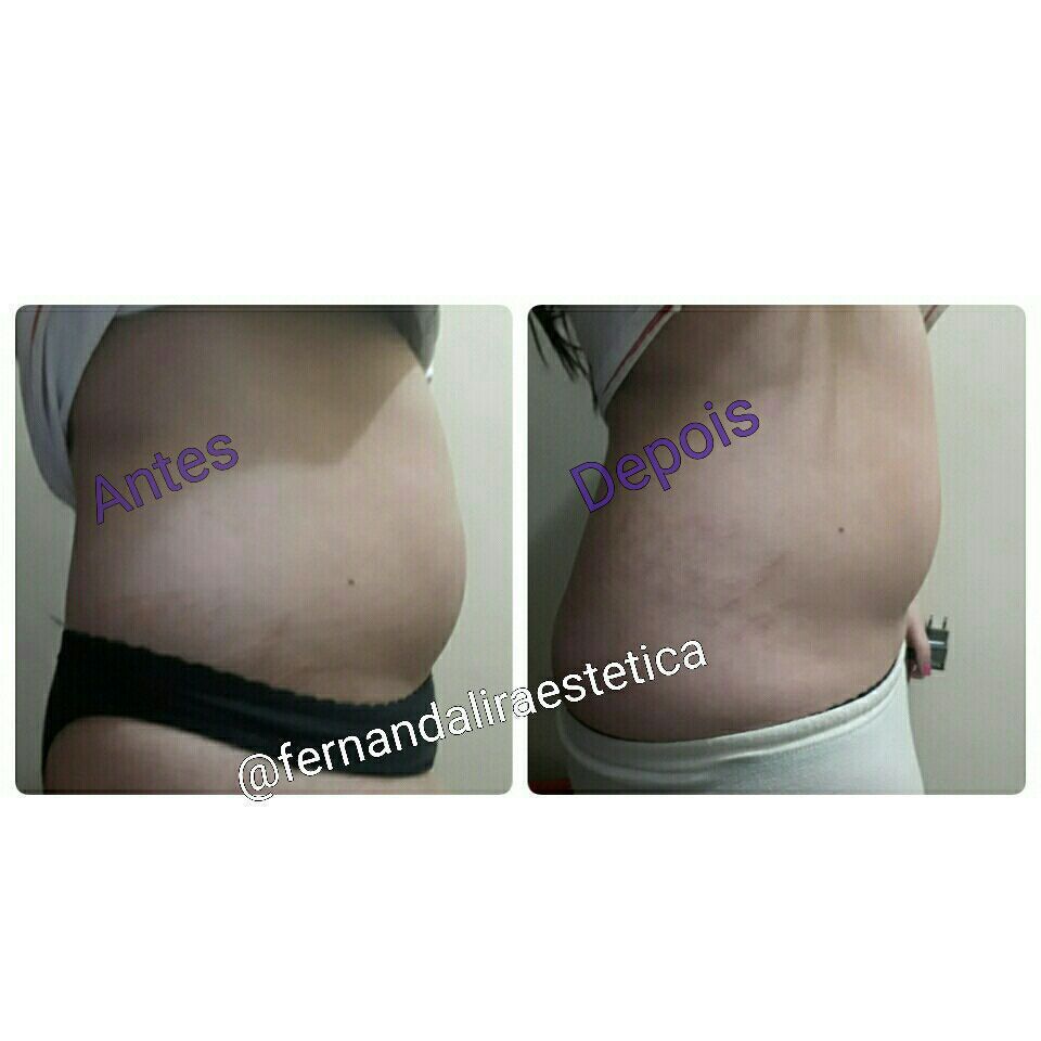 Protocolo de redução de medidas aqui no meu pequeno espaço ❤ 1 sessão só estética esteticista designer de sobrancelhas
