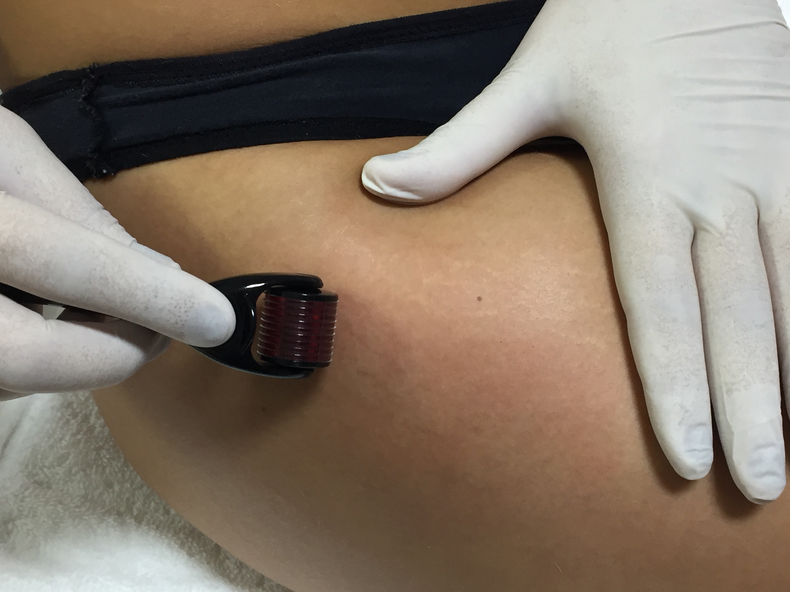 Dermaroller  estética esteticista