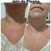 Jato de plasma, retirada de pintas sobressalentes.