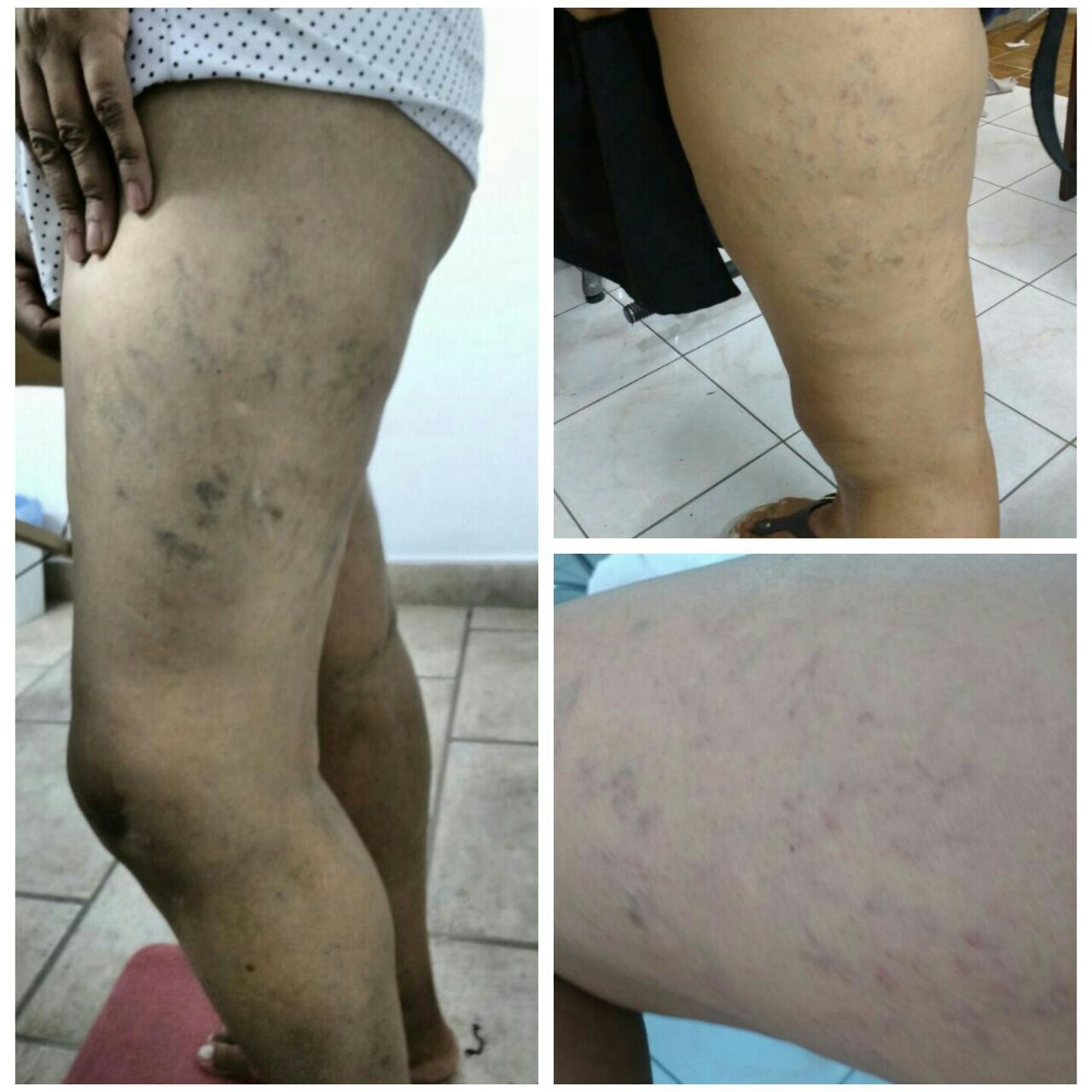 Procedimento injetável em microvasos. Foto maior: antes do procedimento. Foto de cima: 24hs após o procedimento. Foto de baixo: 20 dias após o procedimento. #enfermagemestetica #amooquefaco #clientefeliz #satisfacao.  estética enfermeiro(a)