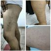 Procedimento injetável em microvasos. Foto maior: antes do procedimento. Foto de cima: 24hs após o procedimento. Foto de baixo: 20 dias após o procedimento. #enfermagemestetica #amooquefaco #clientefeliz #satisfacao. 