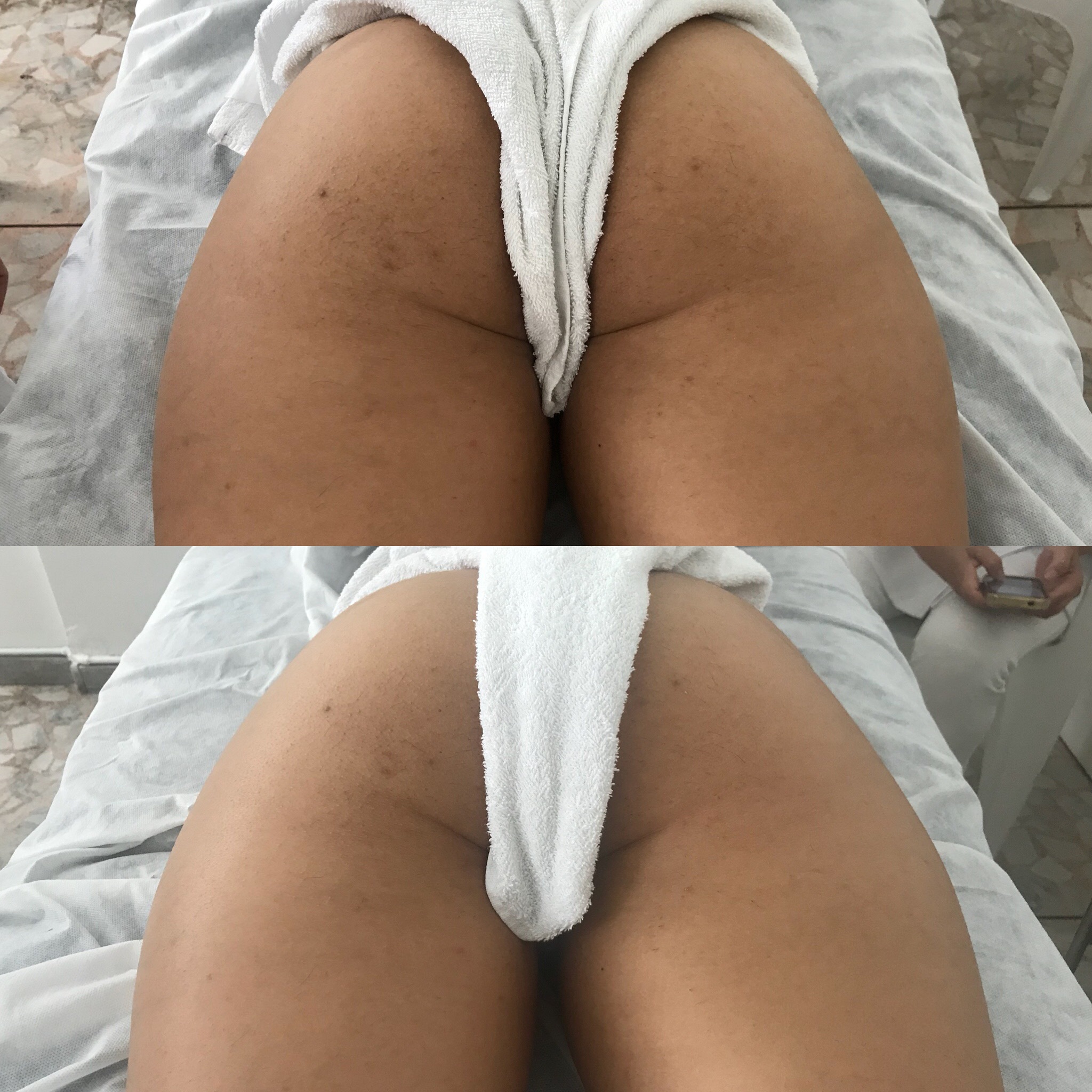 Antes e depois massagem modeladora  estética fisioterapeuta esteticista massoterapeuta