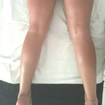 Drenagem lipodetox resultado ja na primenria sessão 