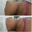 Drenagem lipodetox resultado ja na primenria sessão.