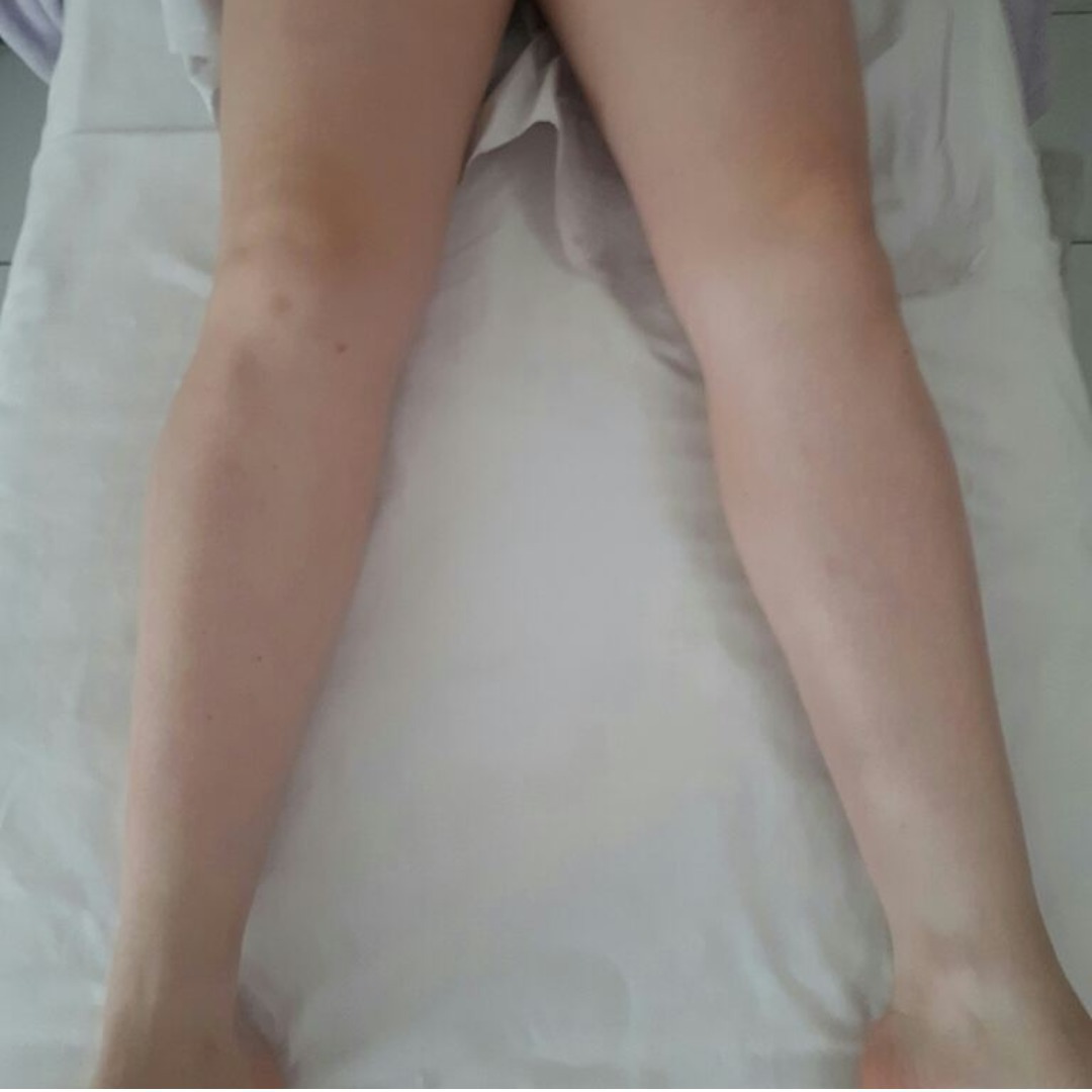 Drenagem lipodetox resultado ja na primeira sessao. estética esteticista massoterapeuta designer de sobrancelhas depilador(a)