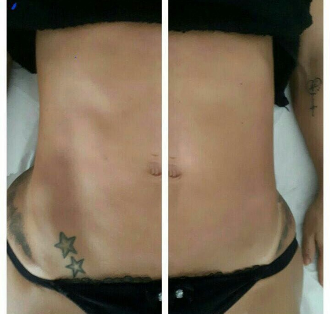 Drenagem lipodetox resultado ja na primeira sessão. estética esteticista massoterapeuta designer de sobrancelhas depilador(a)
