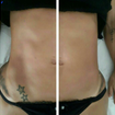 Drenagem lipodetox resultado ja na primeira sessão.