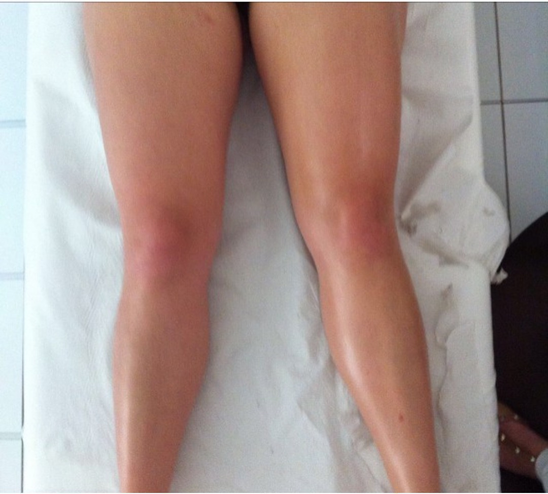 Drenagem lipodetox resultado ja na primeira sessão. estética esteticista massoterapeuta designer de sobrancelhas depilador(a)
