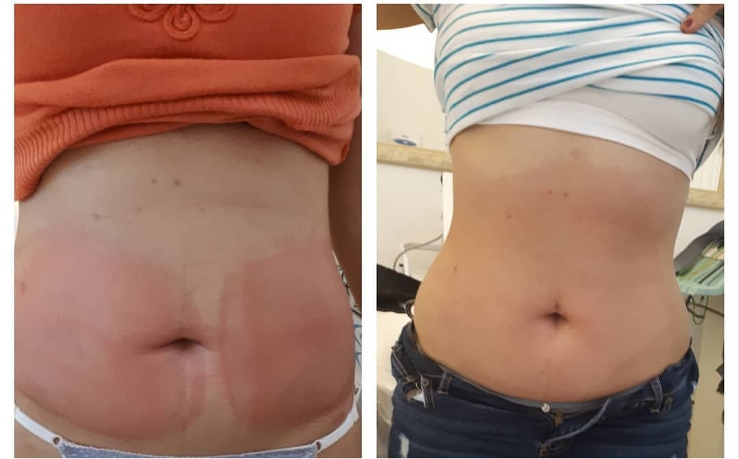 Resultado da criolipolise 7 dias após a aplicação. estética esteticista massoterapeuta designer de sobrancelhas depilador(a)