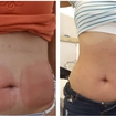 Resultado da criolipolise 7 dias após a aplicação.