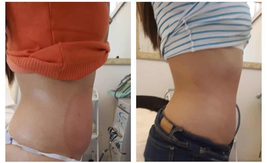 Resultado da criolipolise após 7 dias da aplicação  estética esteticista massoterapeuta designer de sobrancelhas depilador(a)